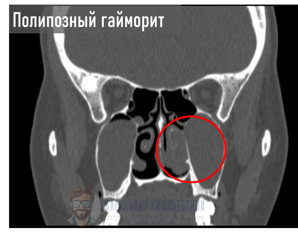 При полипозном поражении пазухи утолщенная слизистая разрастается и формируется полип, который может перекрывать отток из пазухи и мешать носовому дыханию.