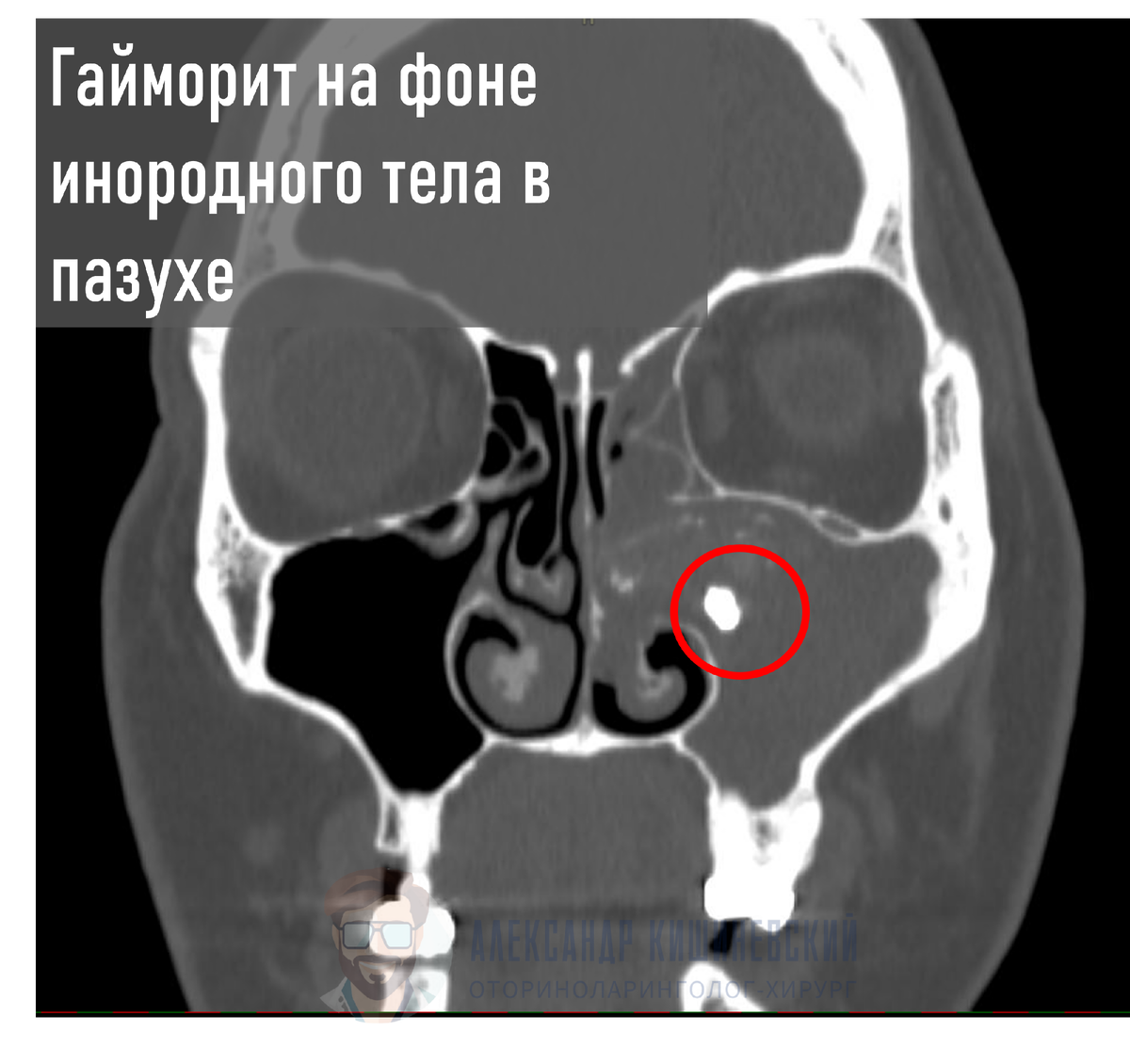 В некоторых случаях источником хронического воспаления в пазухе является пломбировочный материал, попавший туда случайно - яркое белое пятно в красном круге справа. Слева - нормальная пазуха без воспаления. Поможет только операция.