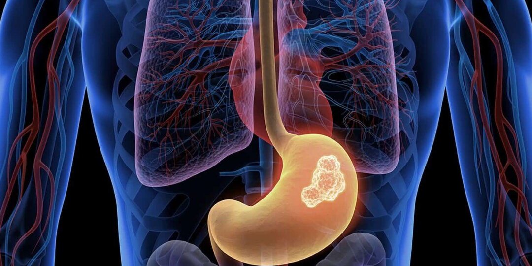 Рак желудка: сигналы, которые подаёт тело