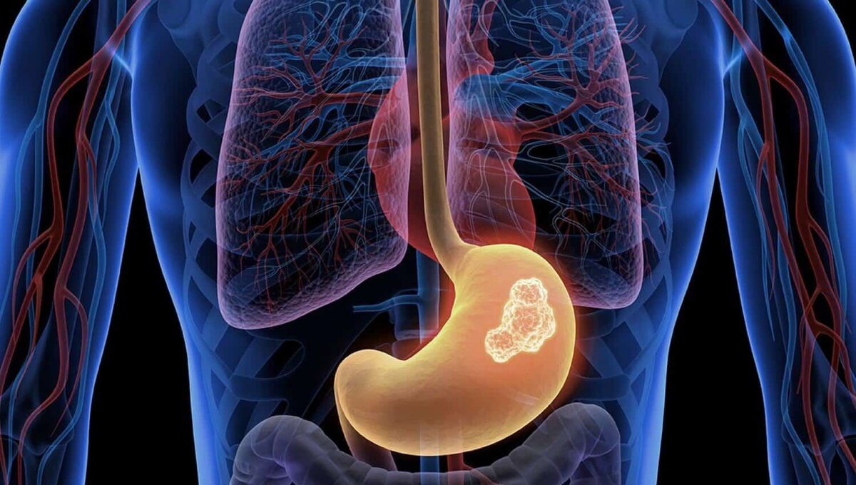 Рак желудка: сигналы, которые подаёт тело