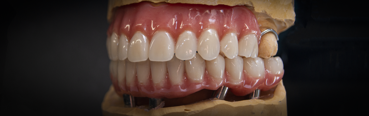 Выполненная зуботехническая работа на модели, до фиксации. Путь исполнения - опишем ниже.