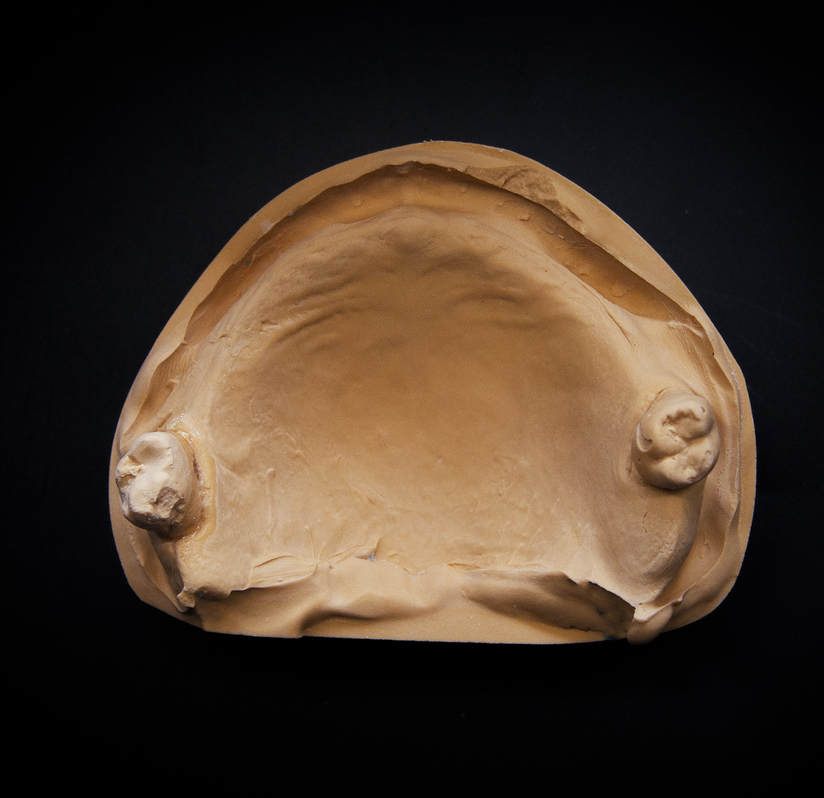 Изготовленная по слепку модель. Ситуация в полости рта пациента на верхней челюсти.