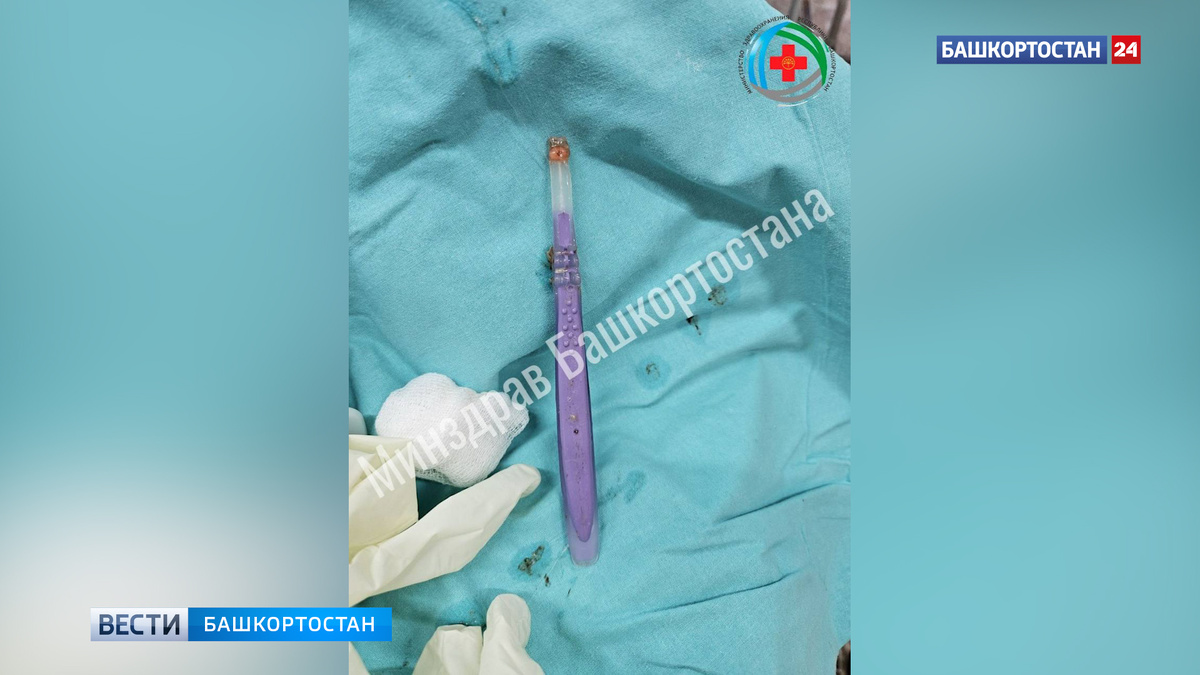    Уфимец проглотил щетку во время чистки зубов