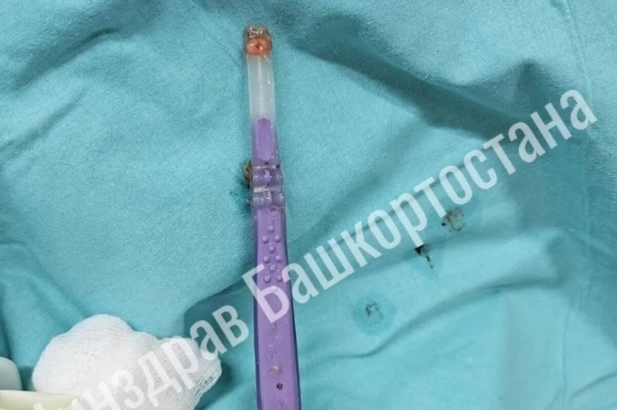   В Уфе врачи из пищевода пациента извлекли зубную щетку