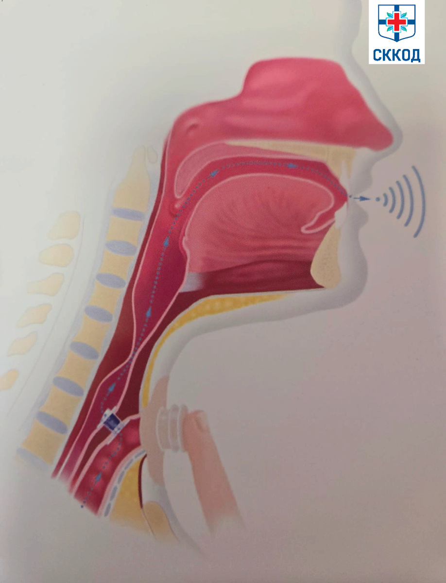 схема воспроизведения голоса после установки протеза