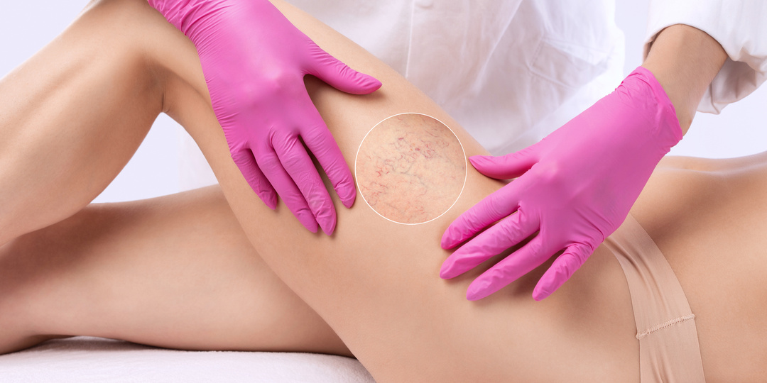 Появились сосудистые звездочки на ногах - что делать?