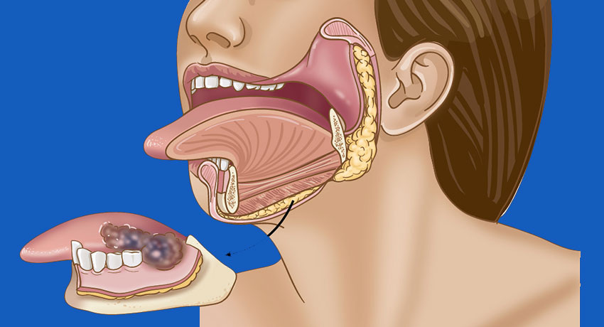 Рак Губ — Как Не Пропустить Первые Изменения