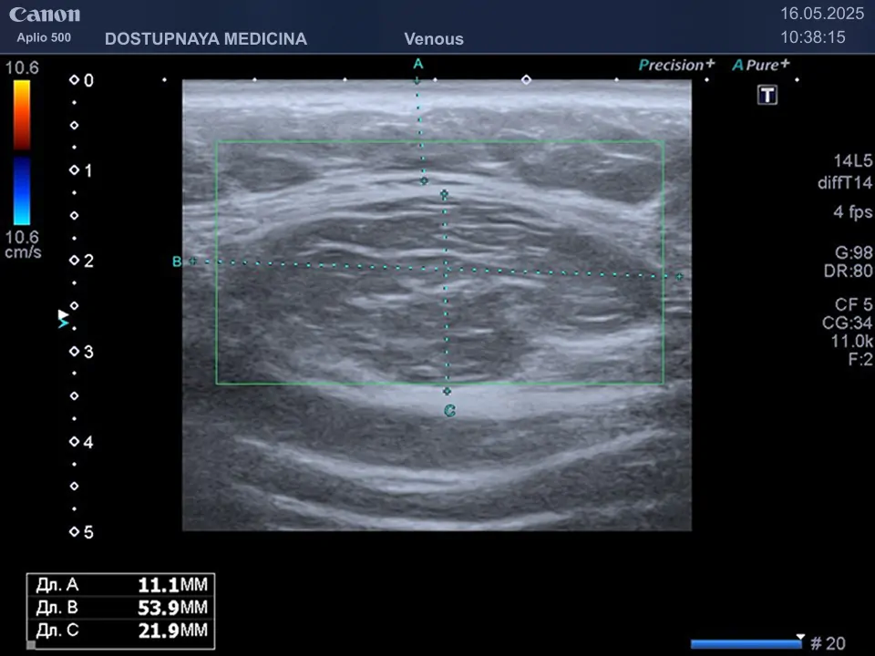                         Клинический пример №1: Фибролипома передней брюшной стенки
