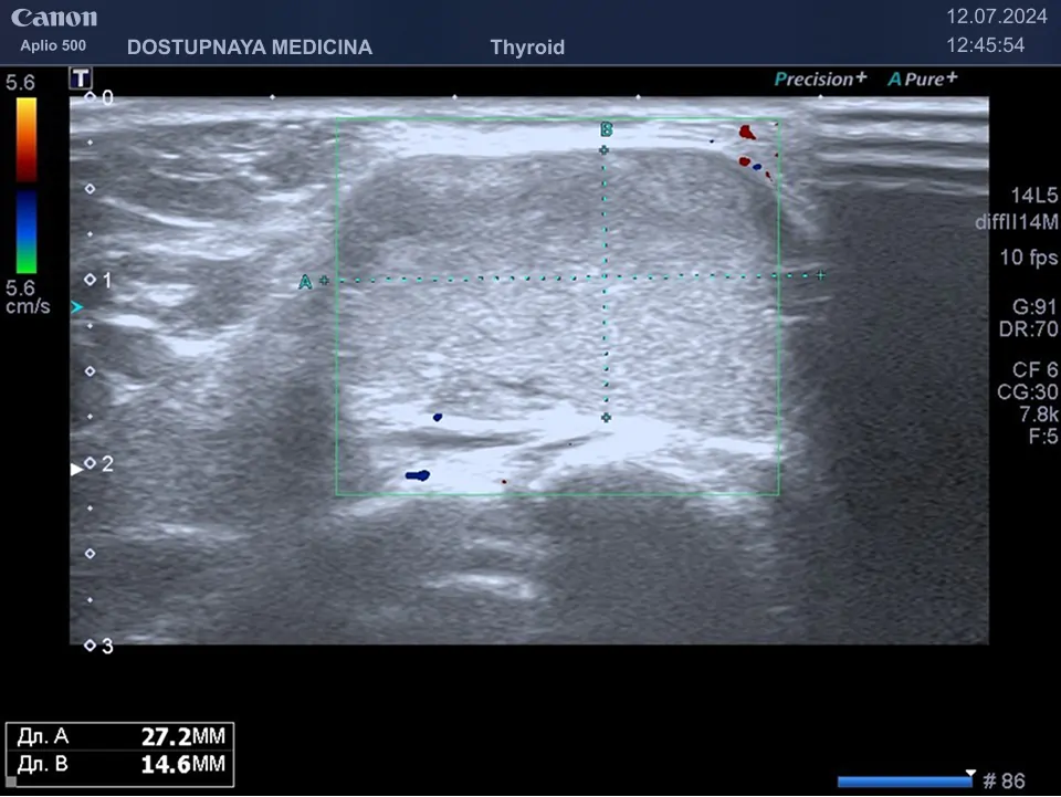                                          Клинический пример №2: Липома в области шеи