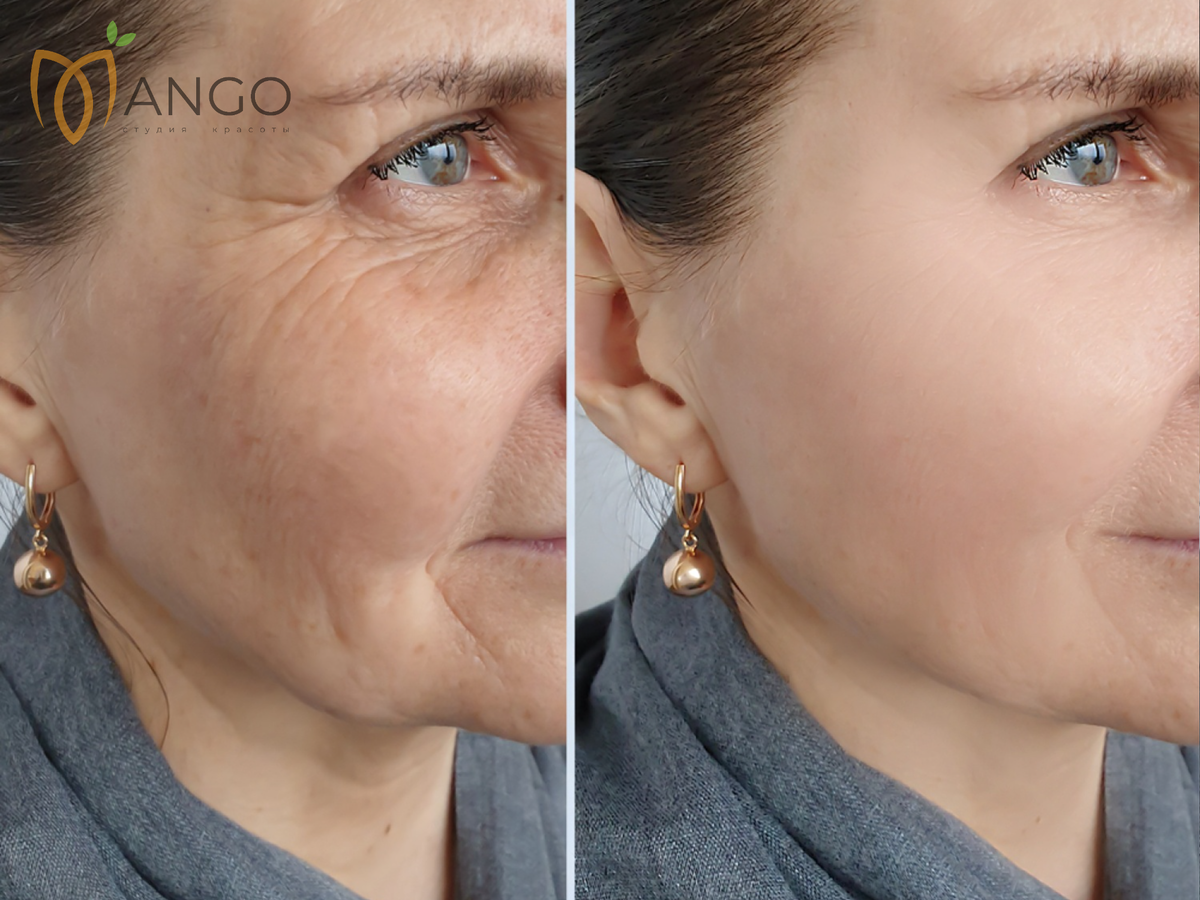 Эффект омоложения кожи после процедур