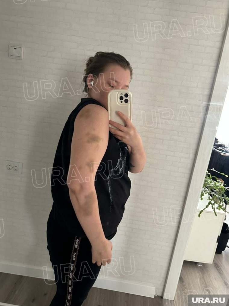 Синяки, которые нанес молодой человек. Фото: URA.RU