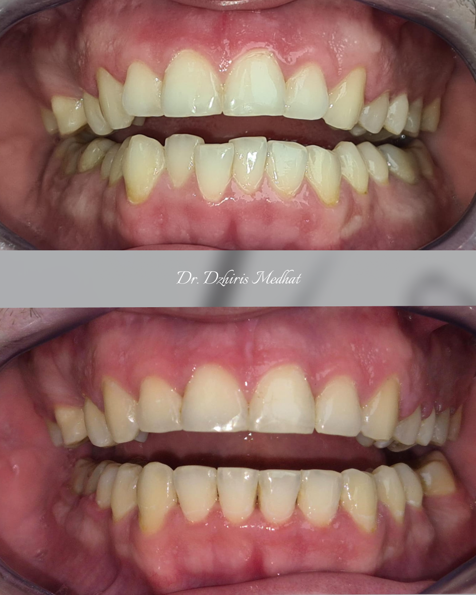 Результат лечения До/После