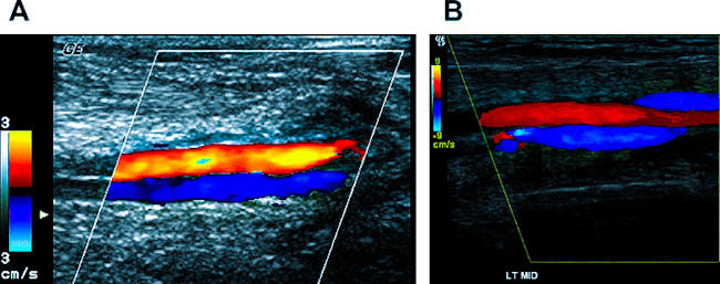 Фото: УЗДС артерий и вен - простейший и быстрый способ оценки кровотока в конечности, но - довольно субъективный способ, важна экспертная оценка.