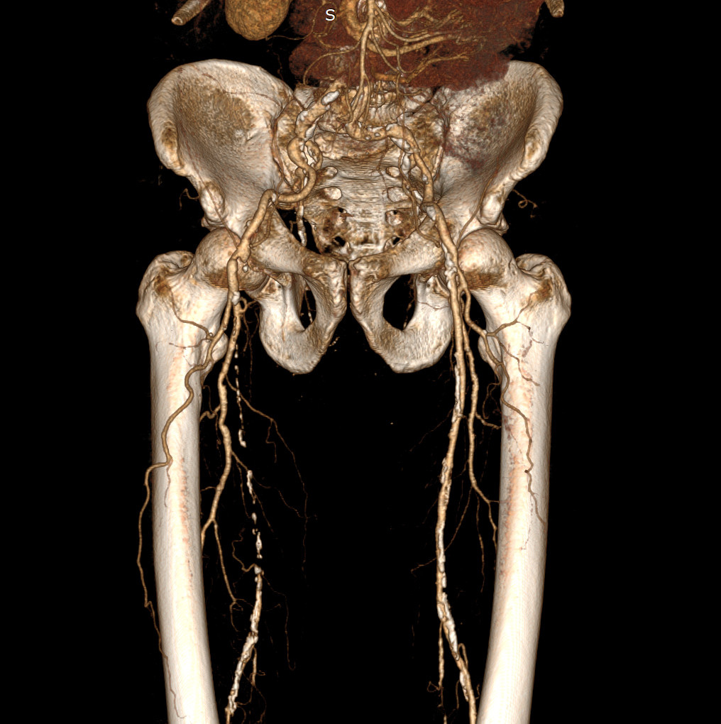 КТ-ангиография артерий нижних конечностей (на фото: 3-х мерная реконструкция сосудистого русла) - наиболее объективный метод исследования артерий нижних конечностей