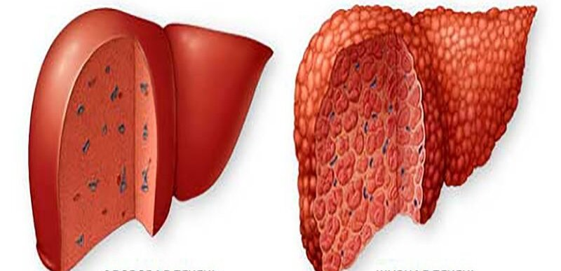 Влияние статинов на печень: мифы, цифры, здравый смысл