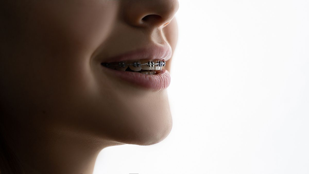 Что взять на перекус  брекетах