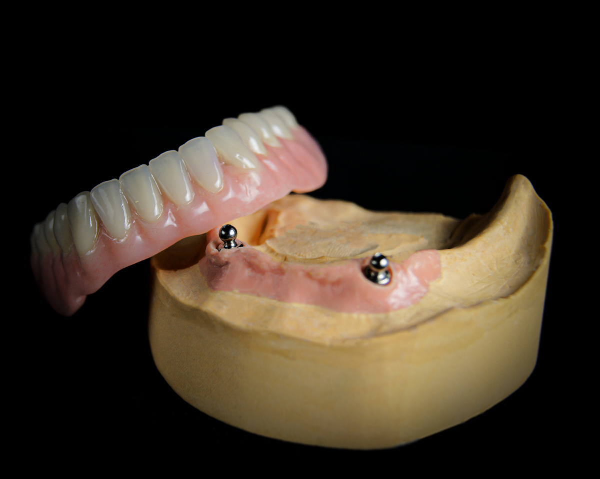 Так называемый зубной протез "на кнопках" для стабильной посадки, как вид конструкции на нескольких имплантатах
