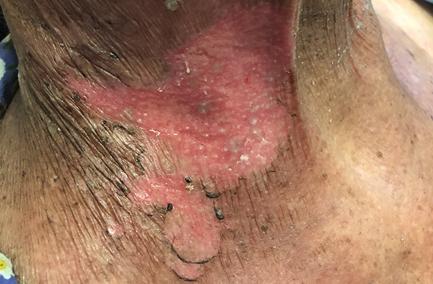 Изменения кожи после лучевой терапии ( такое бывает далеко не у всех)