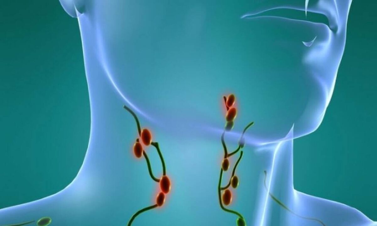 Рак лимфоузлов: почему важно проверяться вовремя