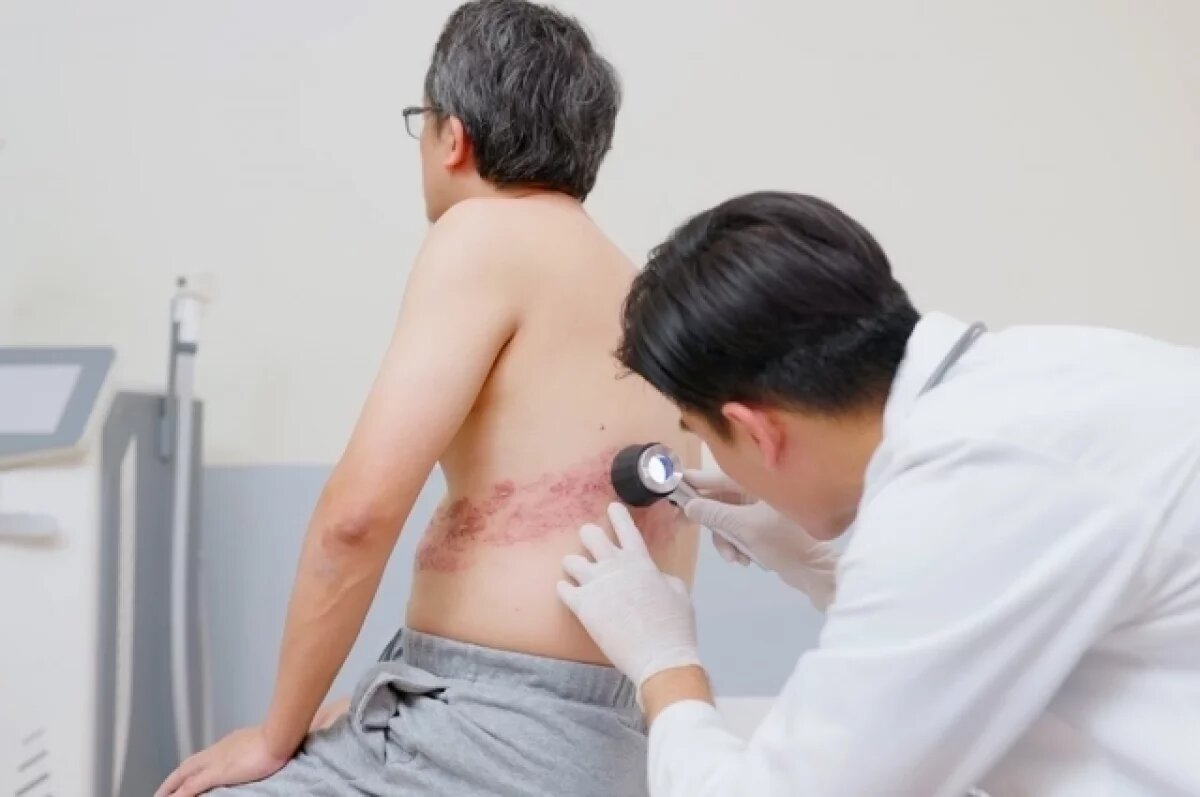    Опоясывающий лишай передаётся через рукопожатие.