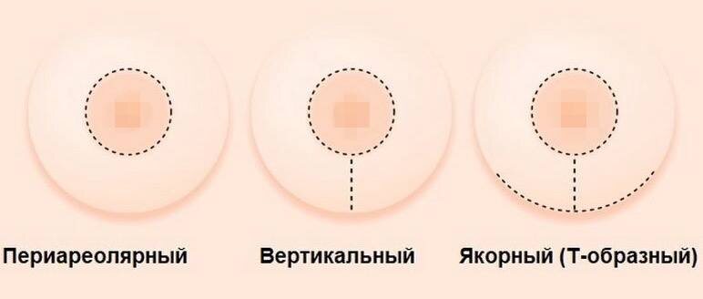 Виды подтяжки груди. Источник: https://hirurg-panaetov.ru/vidy-mastopeksii-podtyazhki-grudi/