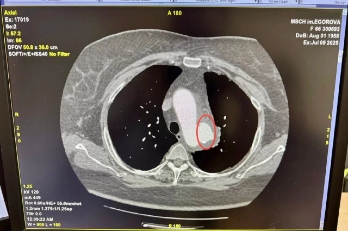    Ульяновские врачи спасли пациентку с аневризмой аорты