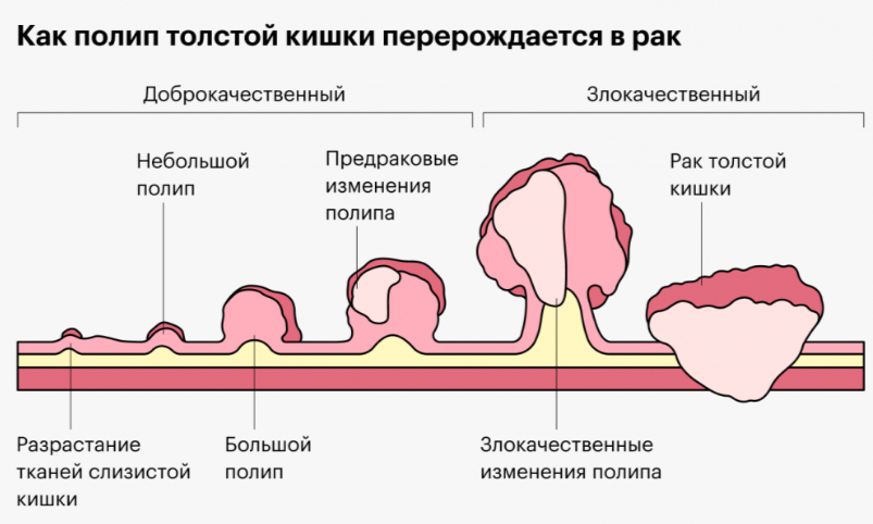 Чем раньше полип обнаружен, тем проще и безопаснее его удалить.