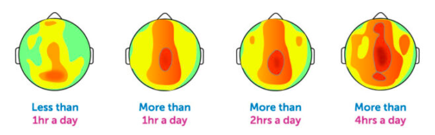 ЭЭГ мозга, сделанные четырём детям в возрасте 18 месяцев. 
Зелёные участки — бета-активность, красные — тета-активность.
