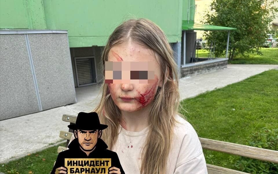    Девочка, на которую напала собака