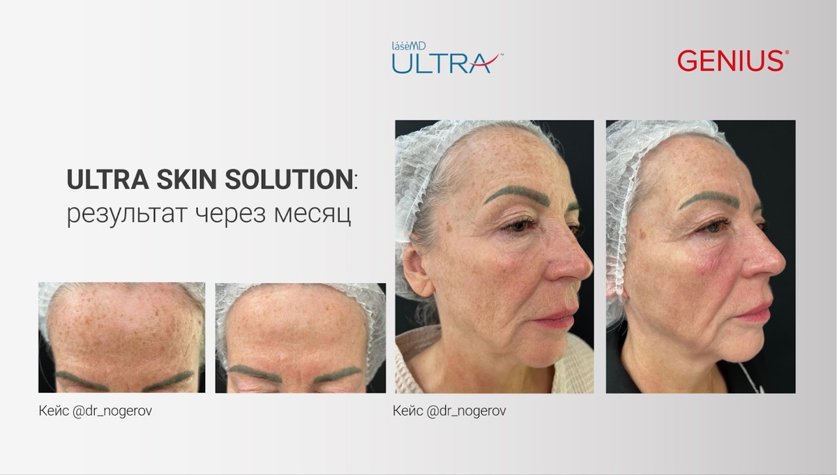 Результат сочетанного протокола