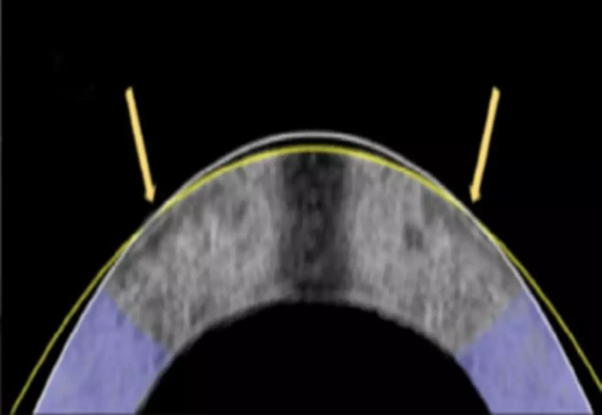    Измененная с помощью электромеханической коррекции роговица кролика, показанная в поперечном сечении. Первоначальная форма — белая линия, скорректированная — желтая линия.