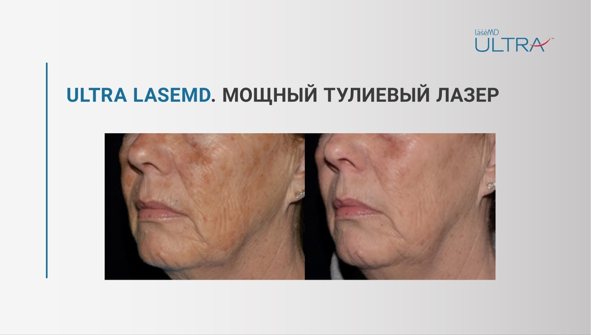 ULTRA LaseMD – лазер для всесезонного омоложения без реабилитации