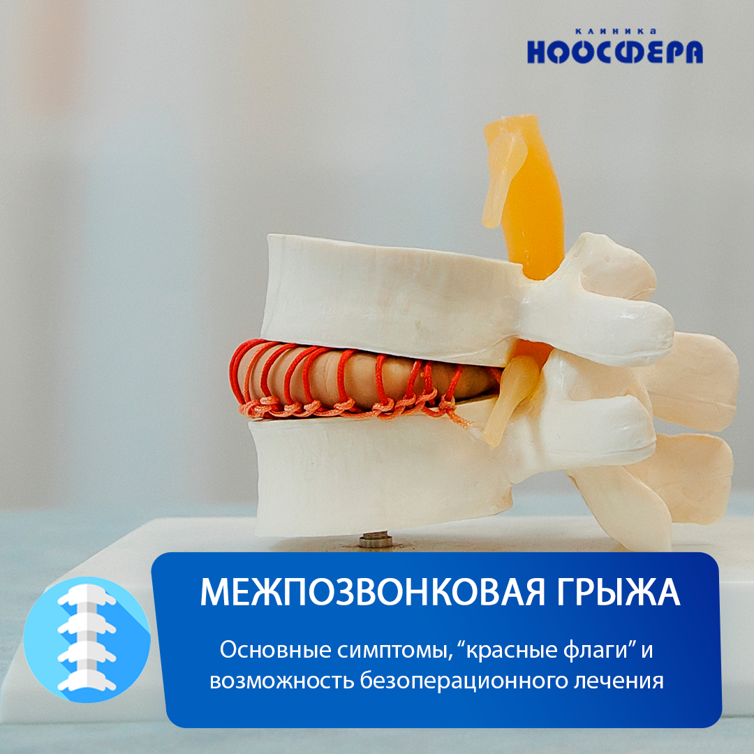Модель грыжи позвоночника