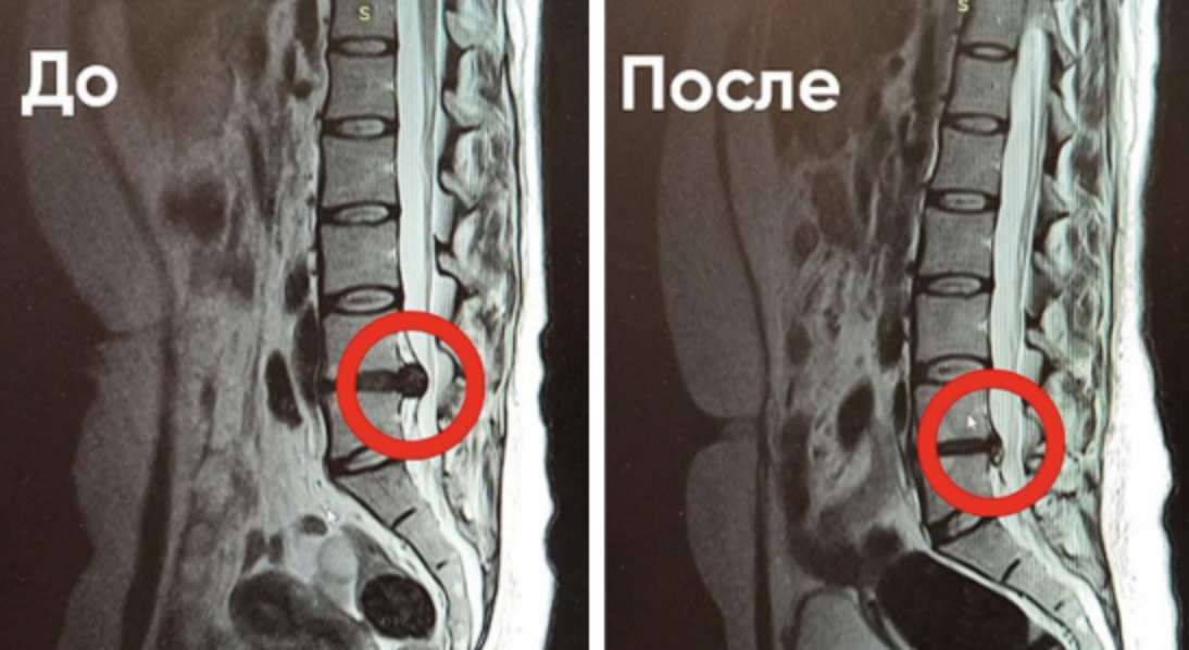 результат безоперационного лечения межпозвонковой грыжи в "Ноосфере"