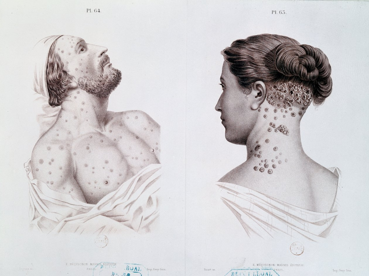 Иллюстрация Т. Синклера из «Атласа венерических болезней» Фримена Дж. Бамстеда, Генри К. Ли, Филадельфия, 1868 г.