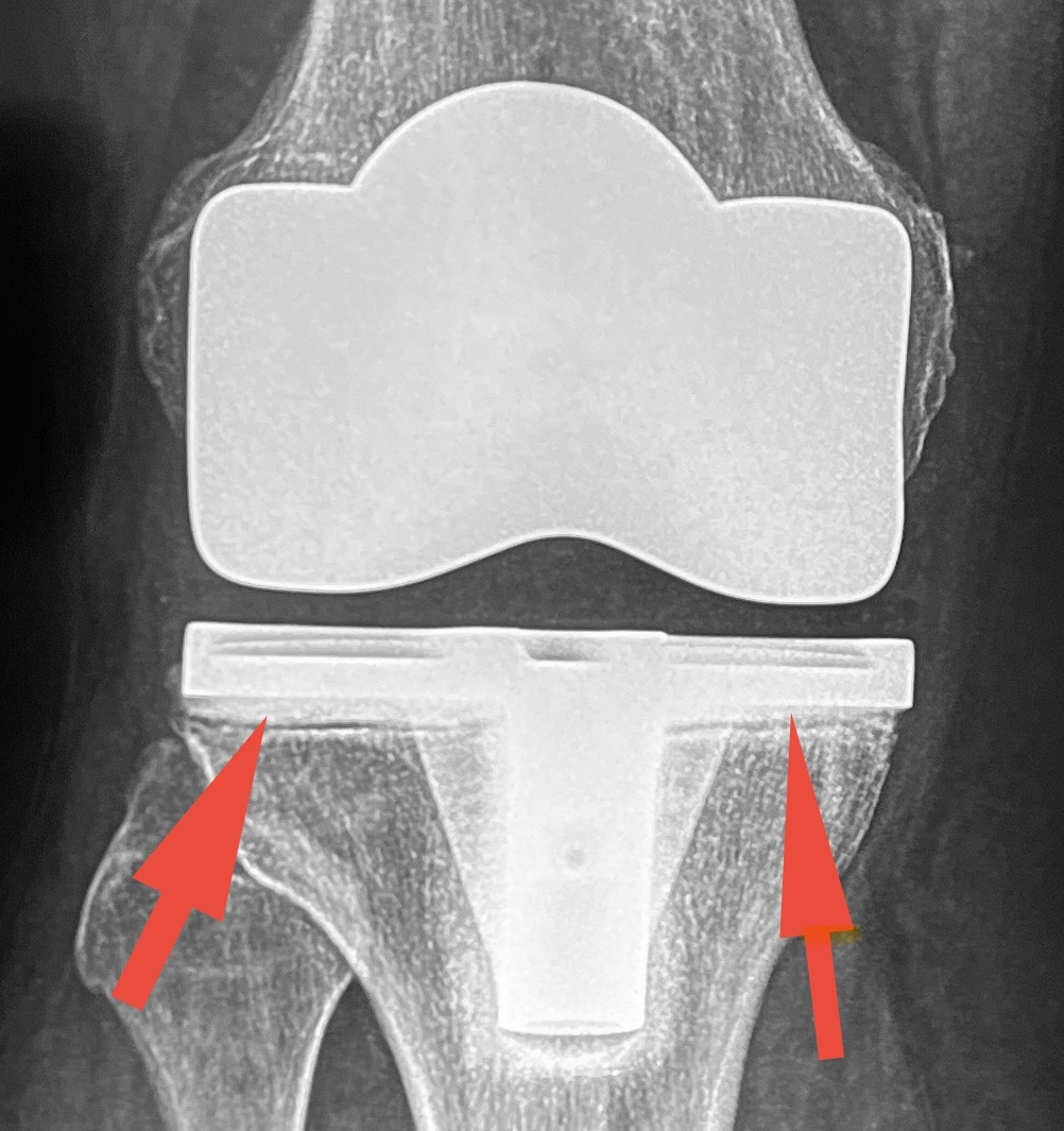 Стрелки указывают на линии, характерные для нестабильности