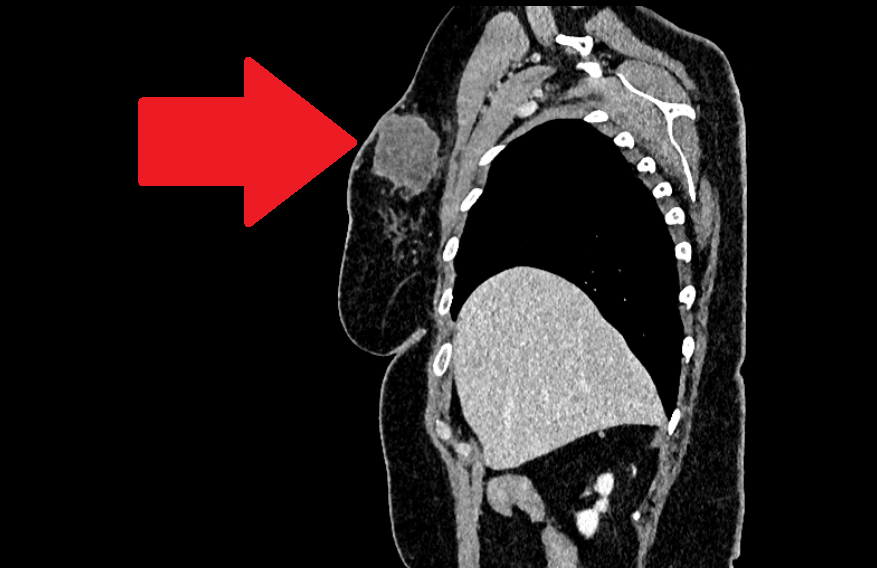 Опухоль правой молочной железы. Компьютерная томография с контрастированием. Боковая проекция