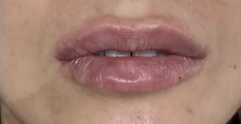 Фото губ после сразу после процедуры