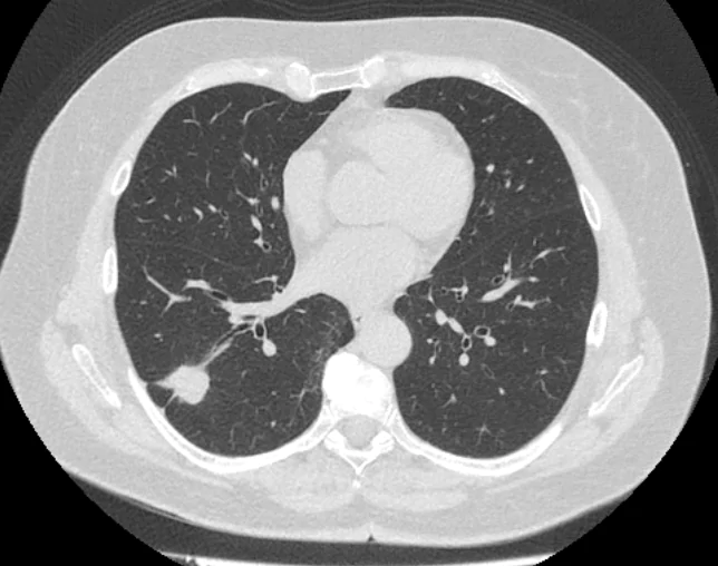                                                          Поражение легких при раке