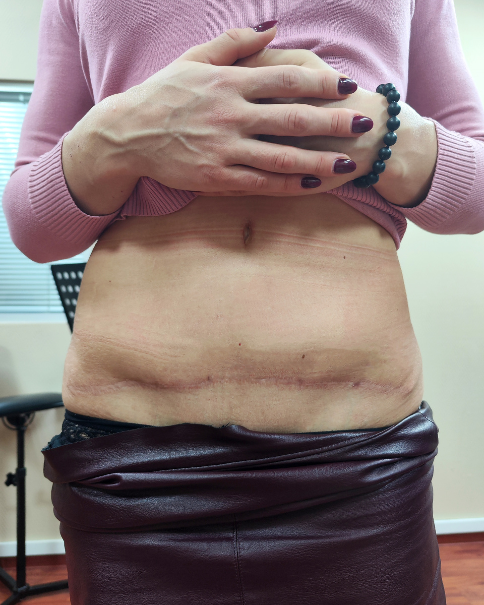 Фото клиентки со шрамом