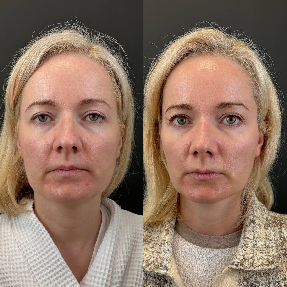 Ринопластика. Эндоскопическая подтяжка лба. 3 месяца после операции. Хирург Остринская Т.В.