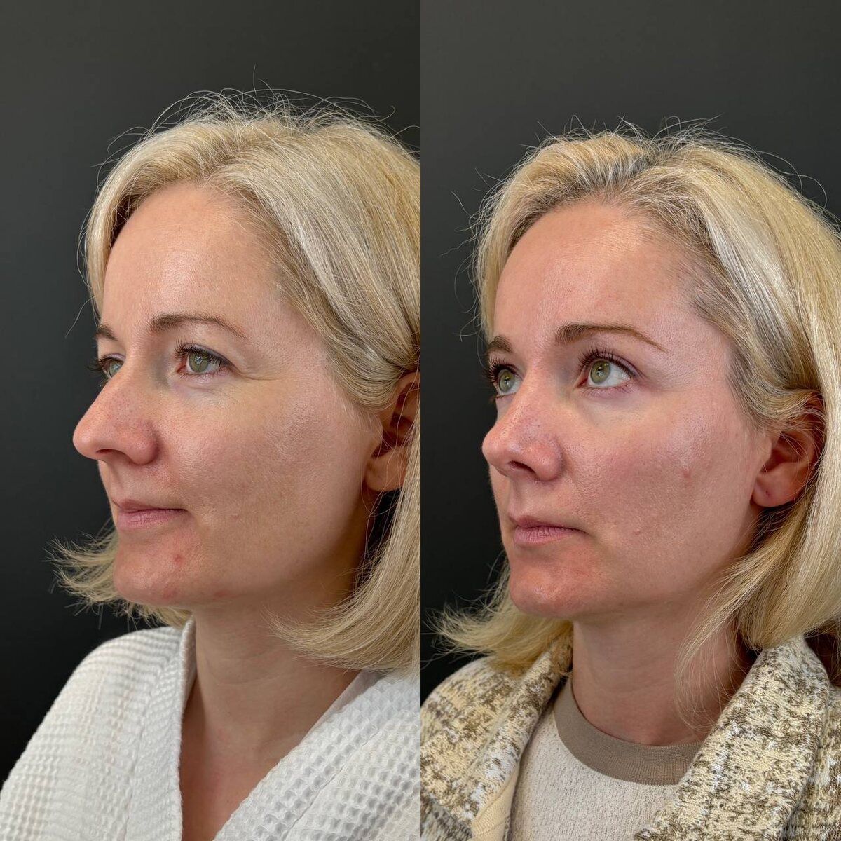 Ринопластика. Эндоскопическая подтяжка лба. 3 месяца после операции. Хирург Остринская Т.В.