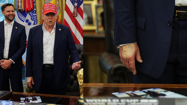    Очередная попытка Трампа скрыть синяк на руке только подогрела интерес СМИ. Reuters/Jonathan Ernst
