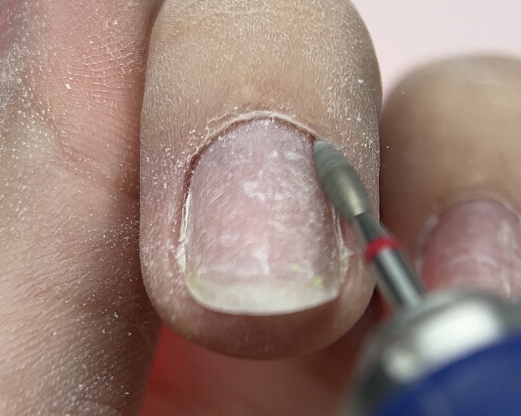 Хорошо вычищаем птеригий, чтобы потом небыло затеков и отслоек