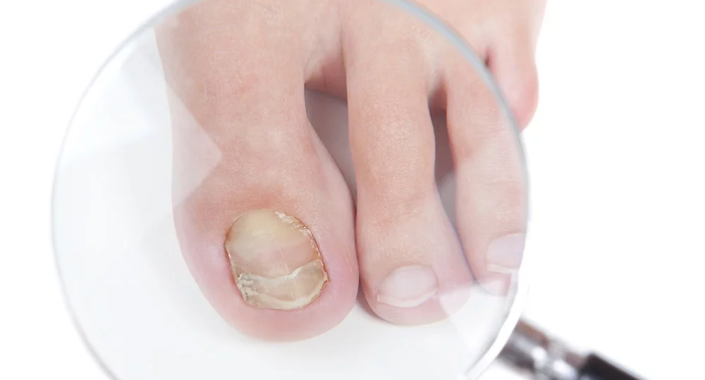 Онихомикоз — все о грибковой инфекции ногтей, которую мы привыкли недооценивать