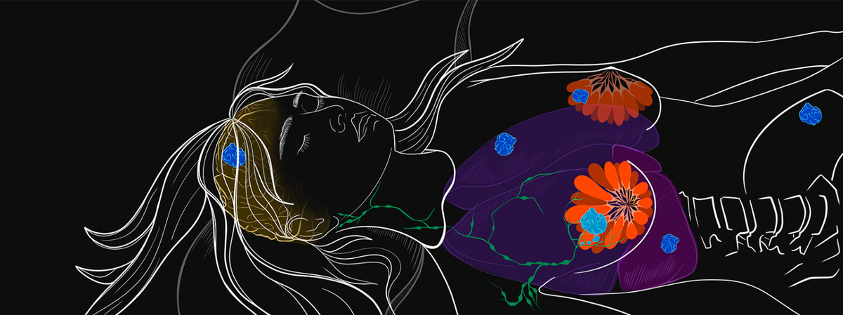 Рак (синим), возникающий в ткани груди, может распространяться на отдалённые участки, часто в лимфоузлы, лёгкое, печень, кость или мозг.
ИЗОБРАЖЕНИЕ: SAYOSTUDIO