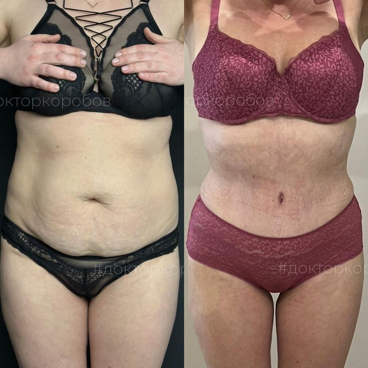Полная абдоминопластика с ушиванием диастаза, круговая липосакция. Результат спустя 3 месяца