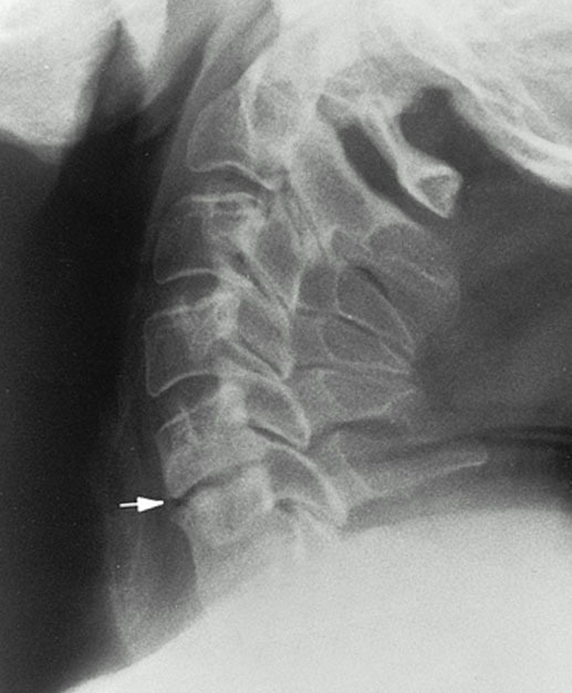 снижение высоты межпозвонкового диска (указано стрелкой). один из признаков остеохондроза.