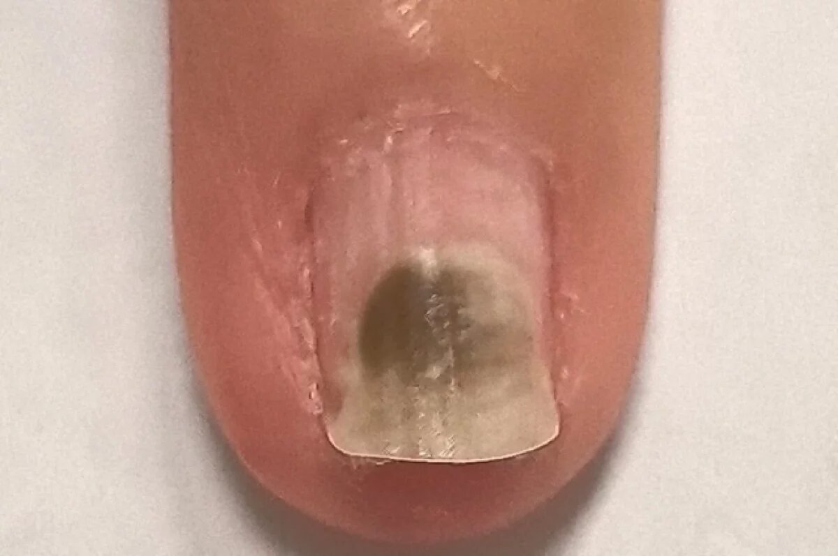    Нижегородцам рассказали о синдроме «зеленого ногтя»