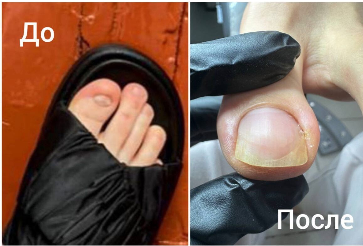 В этом случае подходили к восстановлению комплексно: хирургическая операция + корректирующая система + космецевтика